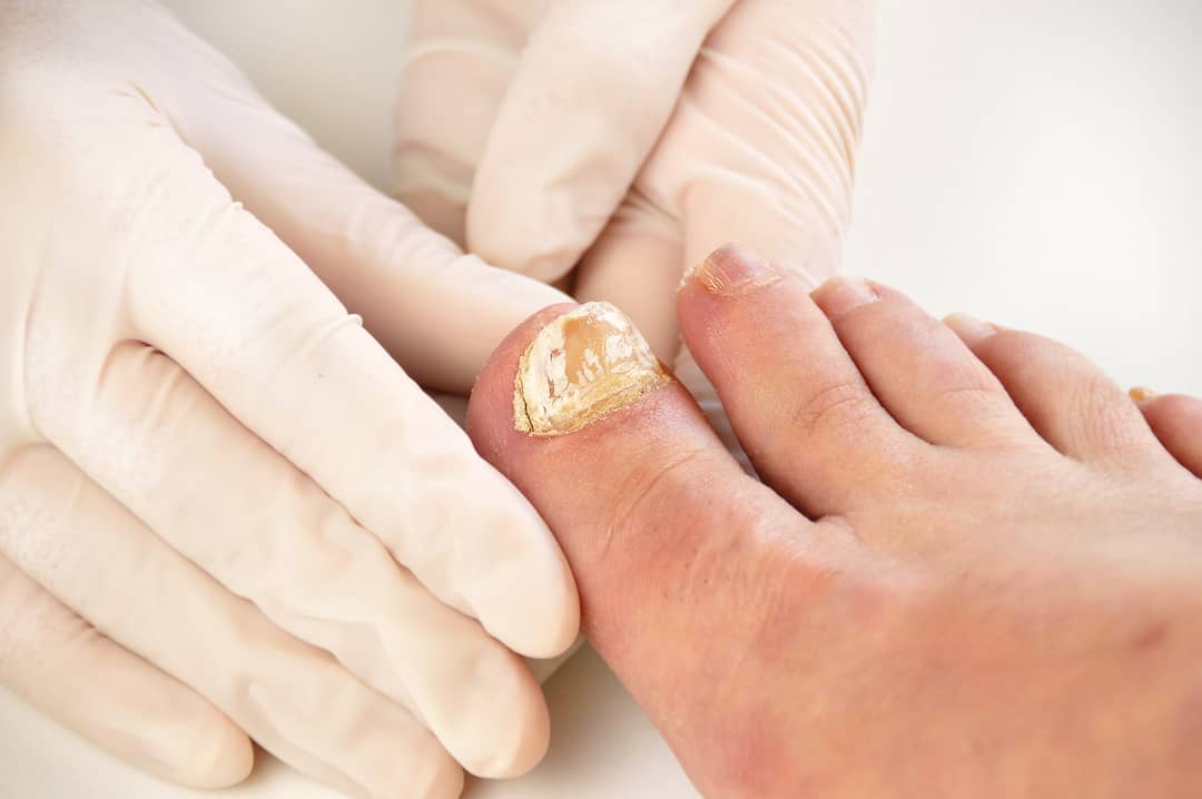 How to Find the Best OTC Nail Fungus Cream Or Ointment for Severe Cases of Toenail Fungi
